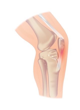 Springerknæ: klogere på smerter i knæet - BeneFiT - BeneFiT